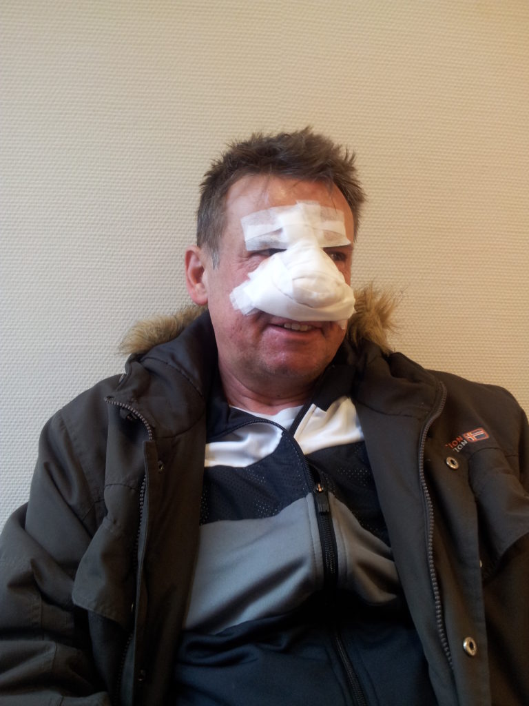 Sonderform Rosacea Rhinophym