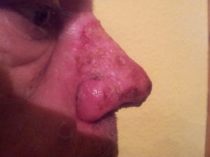 Rhinophym- Abgeheilte Nase nach der Laser OP