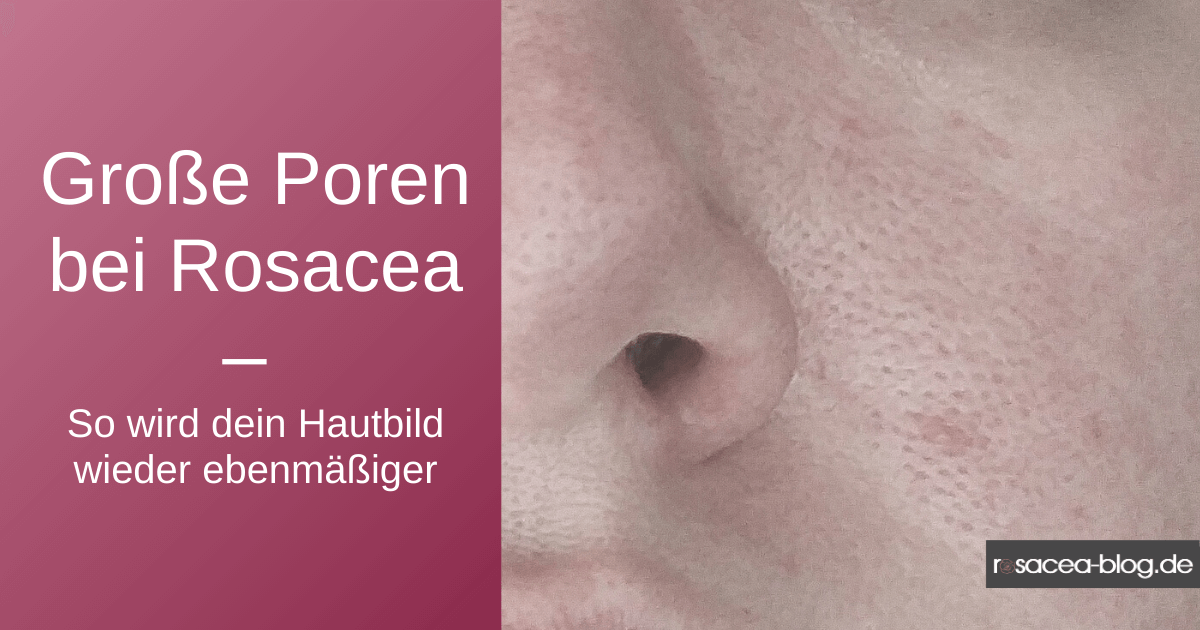 Grosse Poren Bei Rosacea So Wird Dein Hautbild Wieder Ebenmassiger