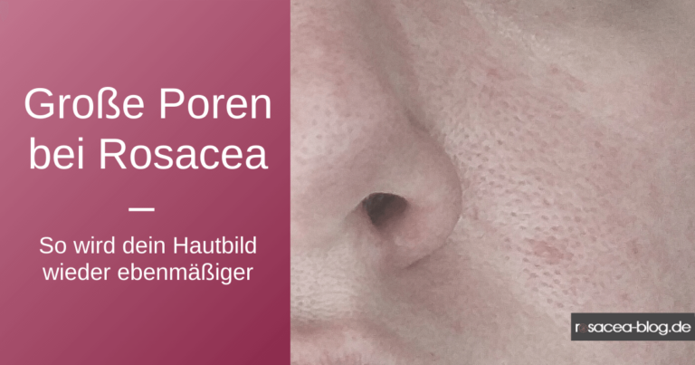 Große Poren bei Rosacea - Nase und Wangen